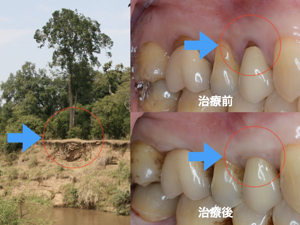 歯周病専門医ブログ⑥歯肉退縮とは！
