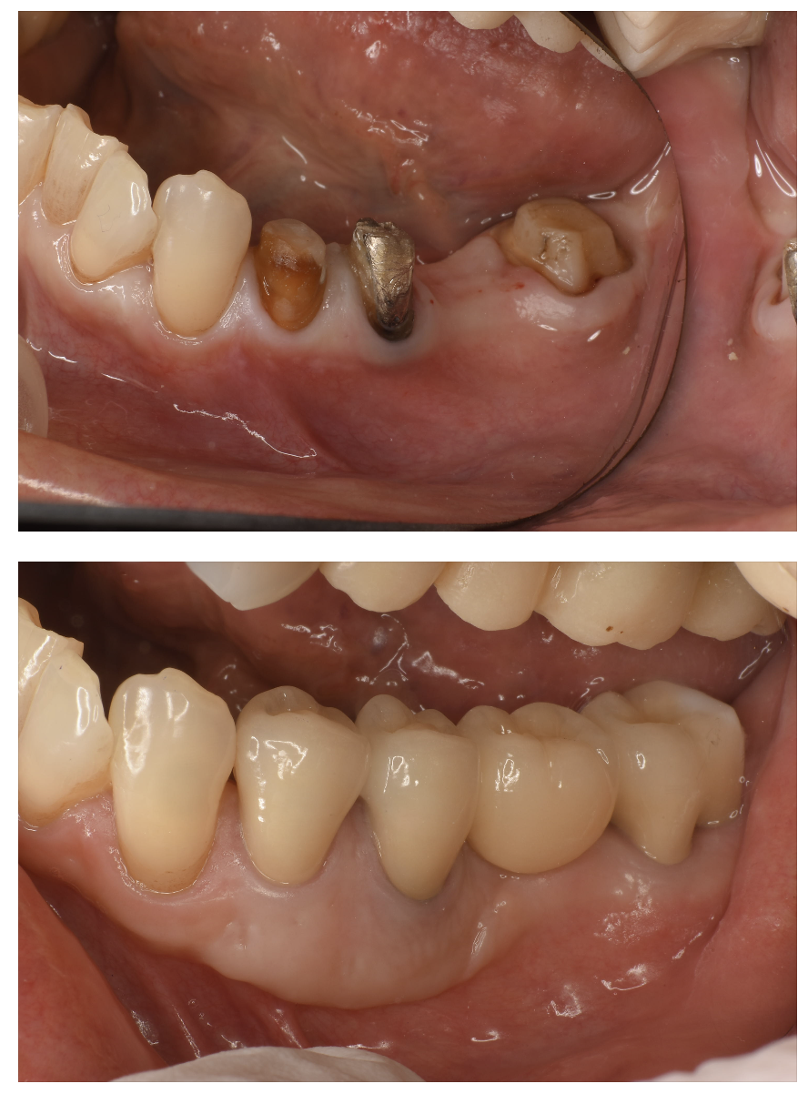 歯周病専門医ブログ(13)歯茎の質