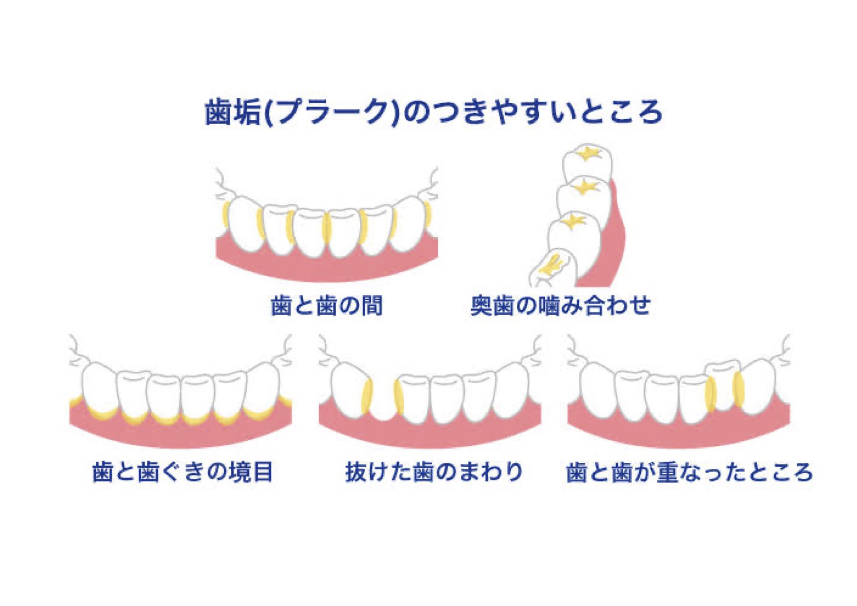 〜プラークコントロール〜