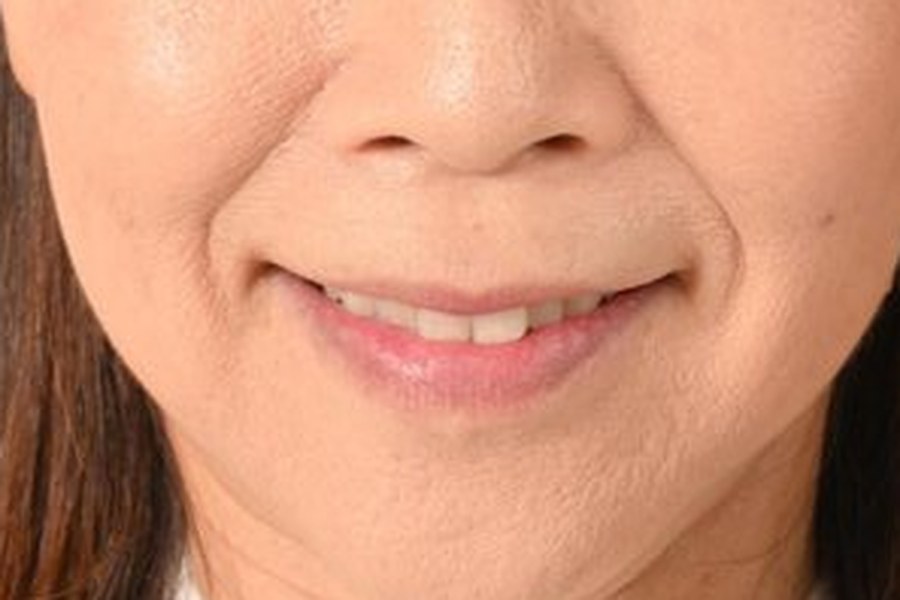 治療前の口元