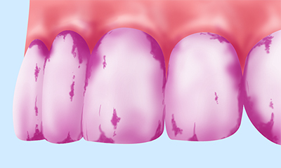 プラーク（歯垢）の染めだし