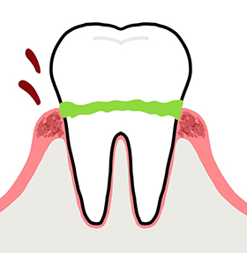 歯周病の原因