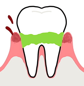 歯周病の原因