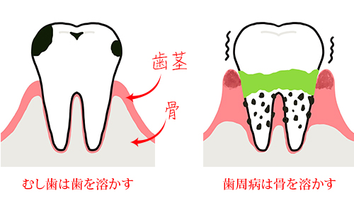 歯周病を克服して、健康な生活を送りましょう