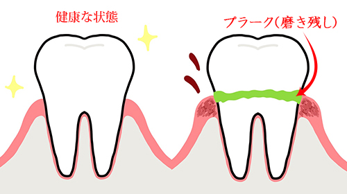 軽度歯周炎