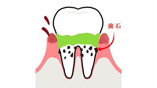 中等度歯周炎