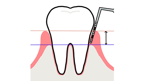 歯周ポケットとは