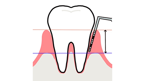 歯周ポケットとは