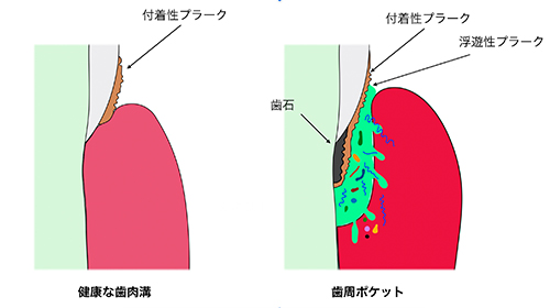 歯周ポケットとは