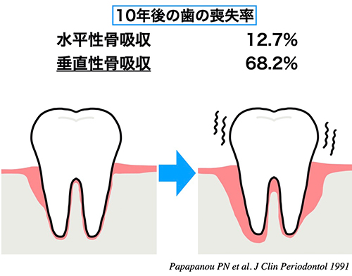 将来多くの歯を抜歯することになってしまう